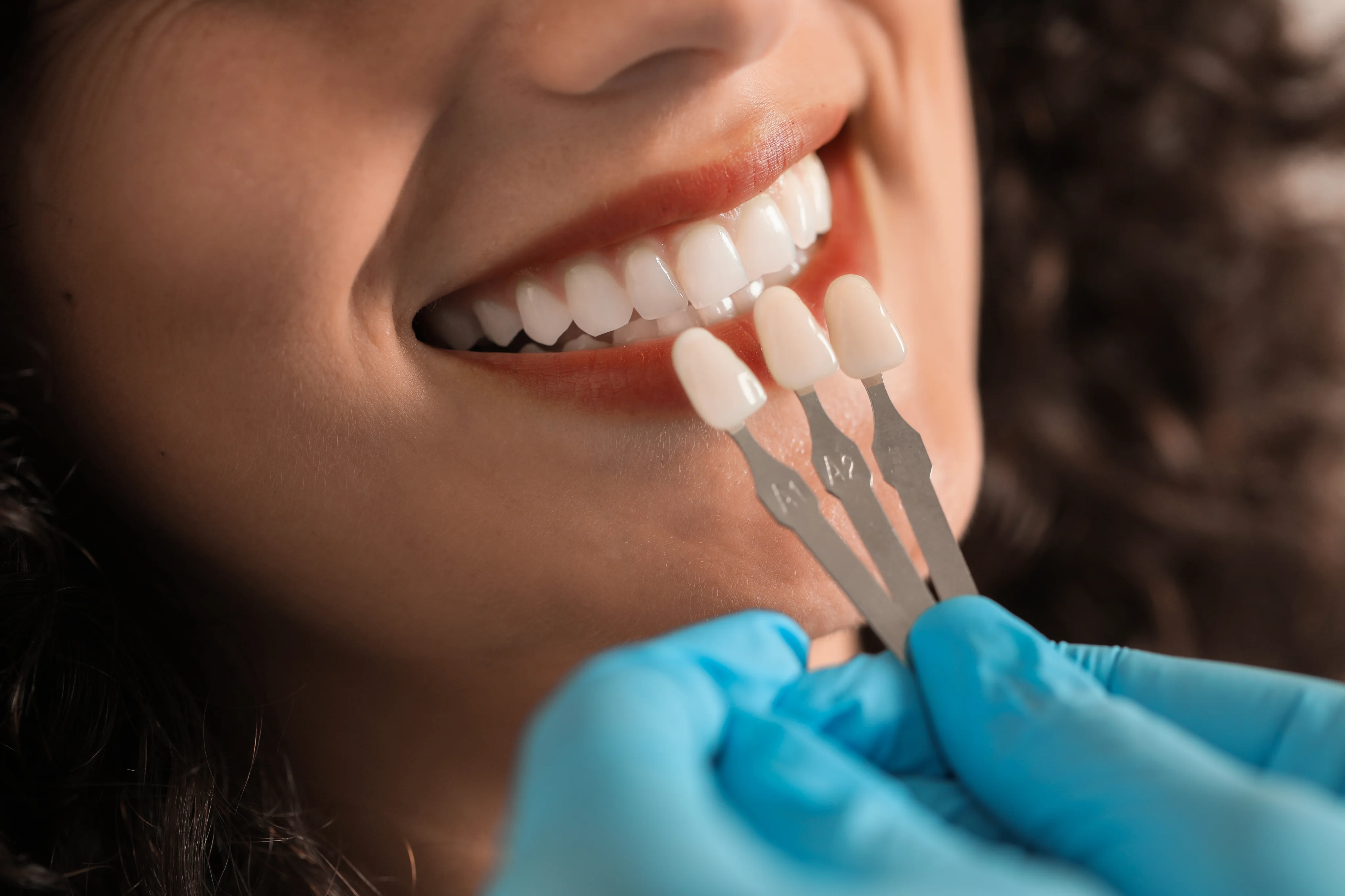 Dental veneers